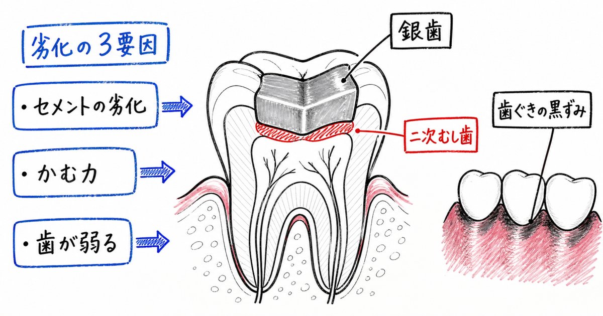 古い銀歯の寿命と交換を考えるべき目安のサイン