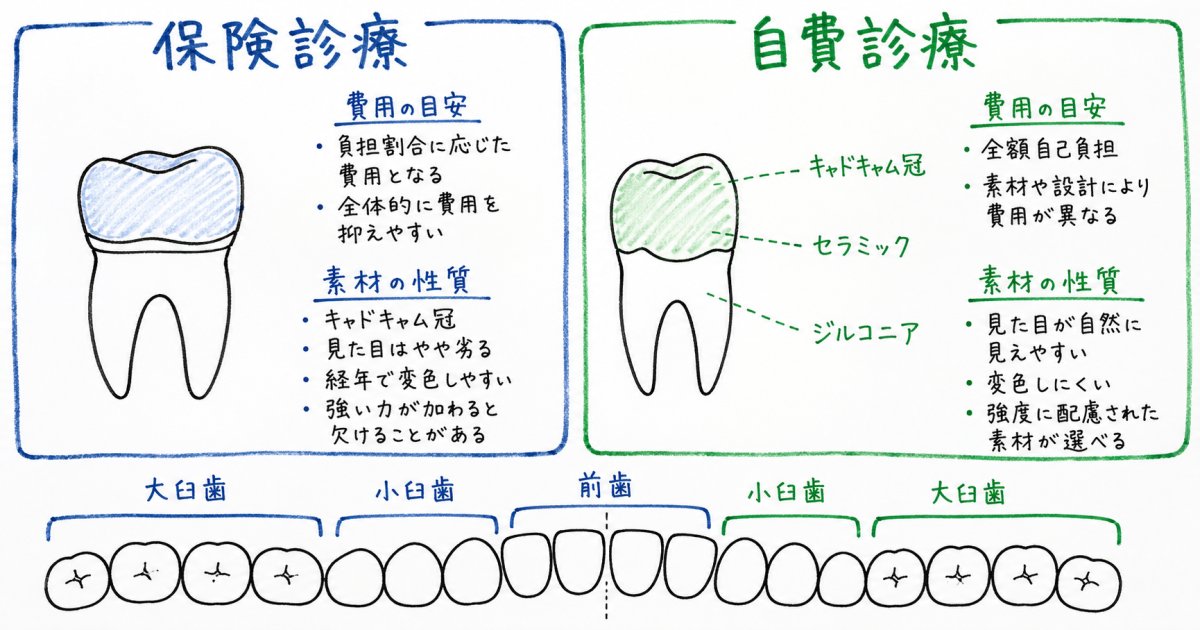 古い銀歯から交換できる白い詰め物・被せ物の種類と費用相場