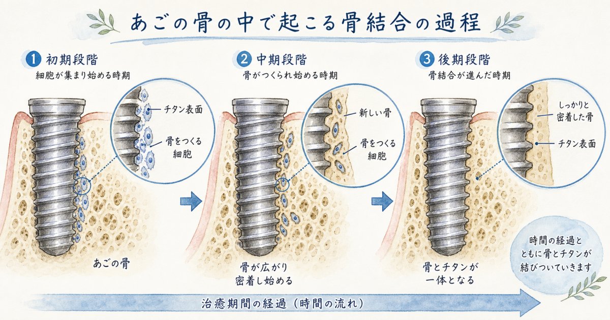 インプラントを構成する3つのパーツとそれぞれの役割