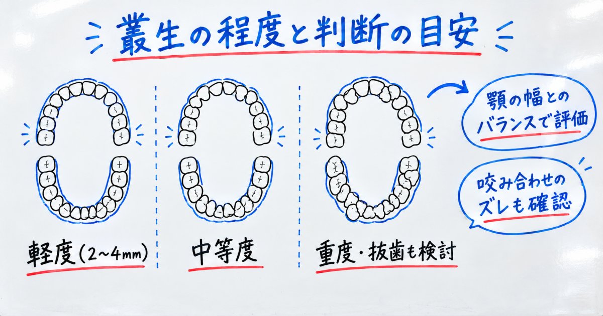 叢生（ガタガタの歯並び）はどこまでマウスピース矯正で対応できるか