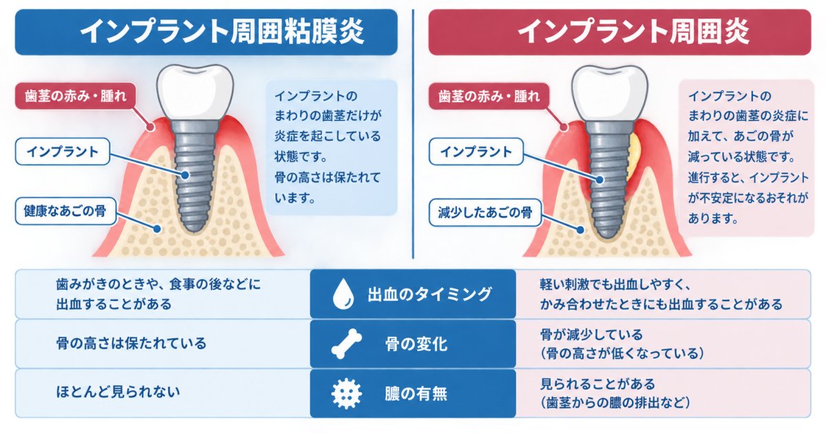 インプラント周囲粘膜炎とインプラント周囲炎の違いをセルフチェック