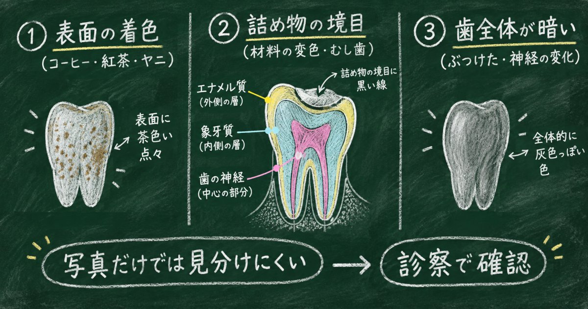 前歯の黄ばみ・変色は、どこが暗く見えるかで原因が異なる