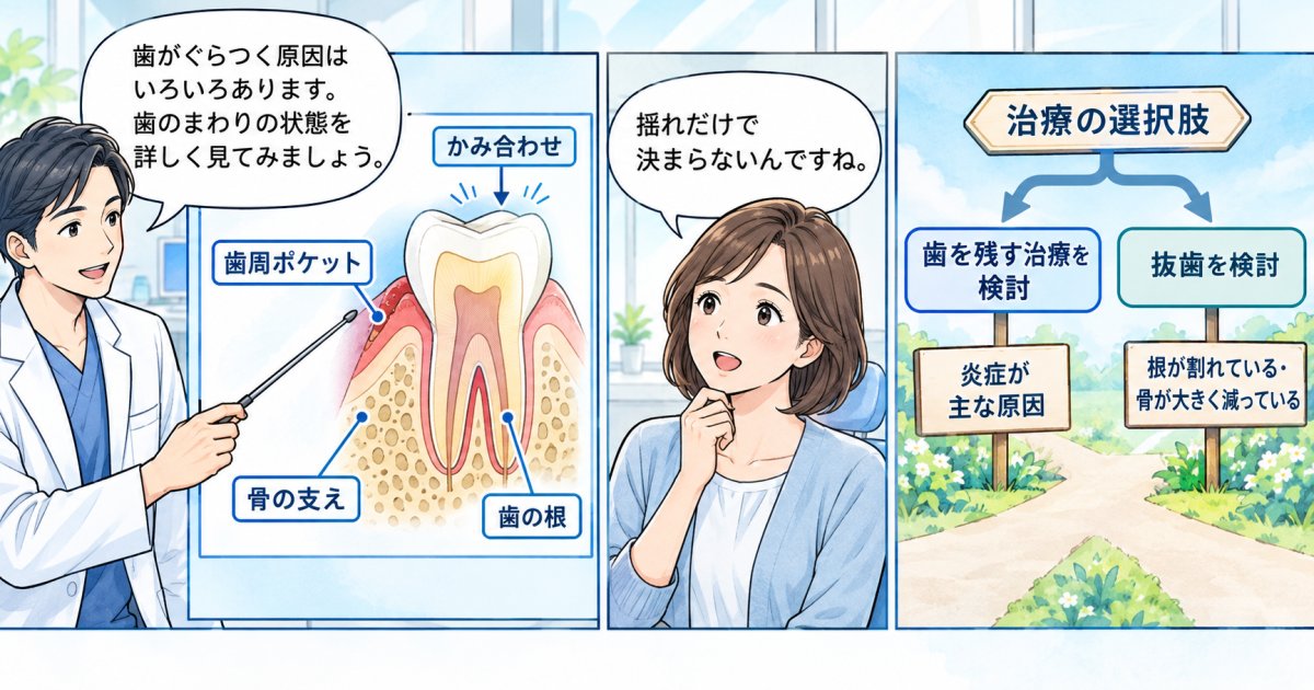 歯周病で奥歯が揺れても、抜歯は何を見て決める？