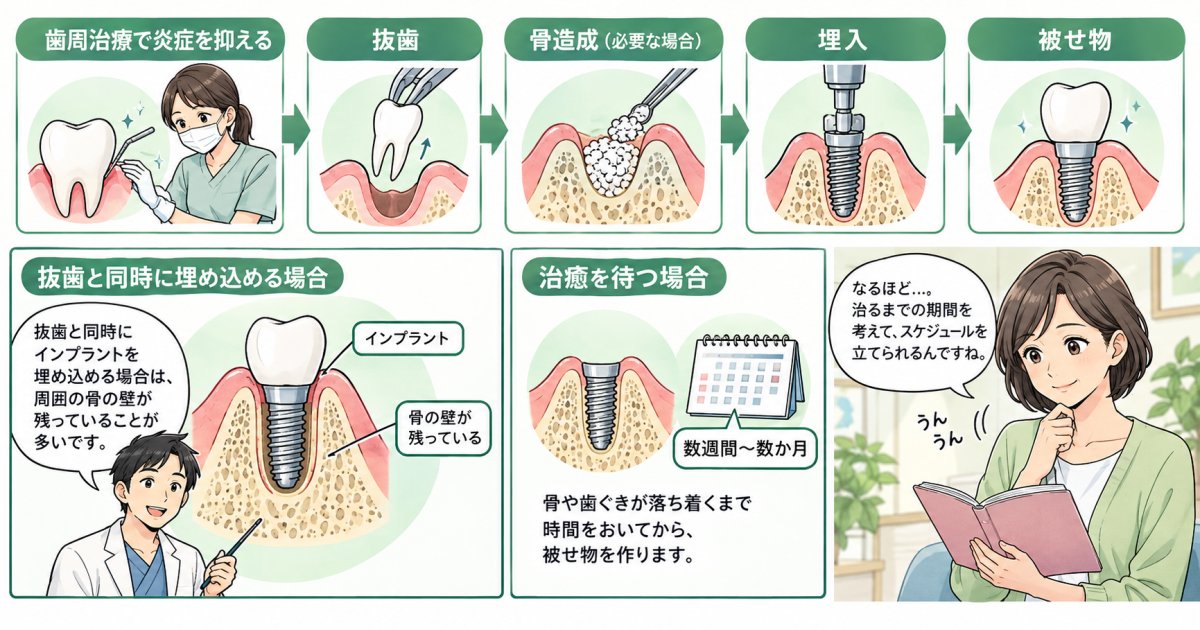 歯周病の抜歯後、インプラントはいつ始められる？