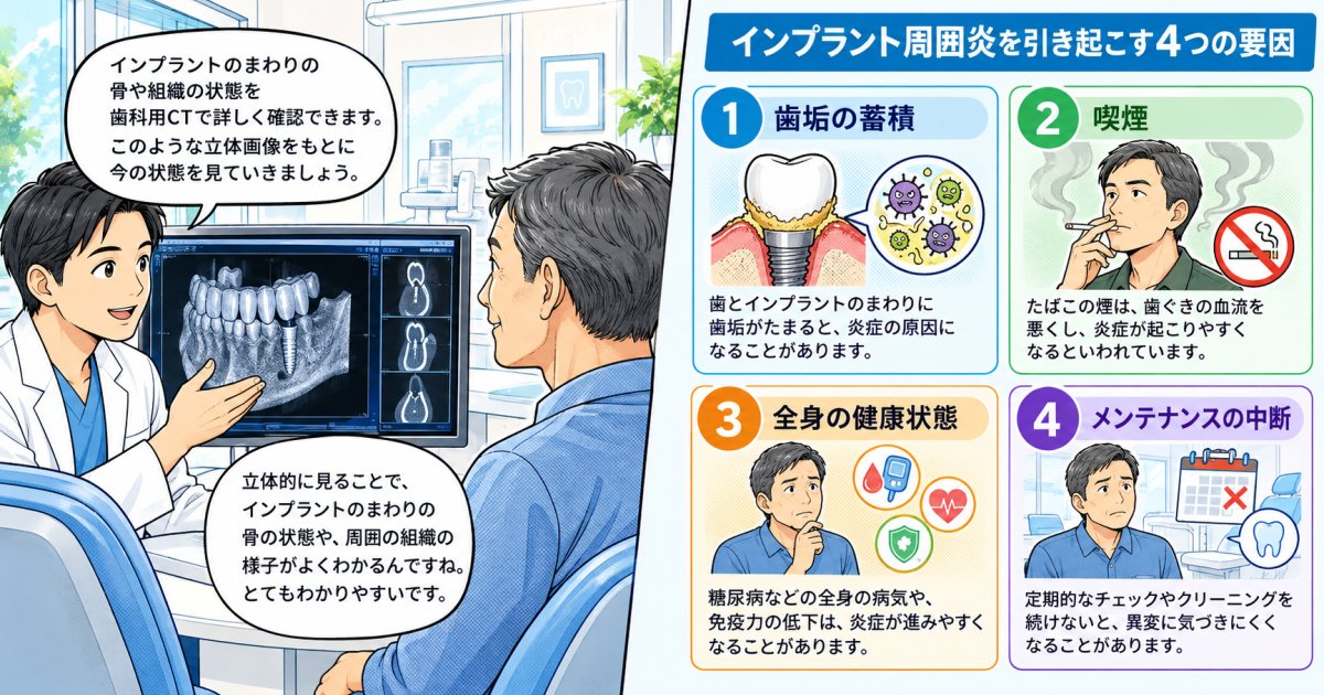 インプラント周囲炎の原因は歯垢・喫煙・糖尿病・メンテナンス中断の重なり、検査で骨の状態を確かめる